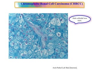 Approach to Renal cell carcinoma(RCC).pptx