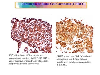Approach to Renal cell carcinoma(RCC).pptx