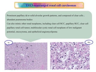 Alveolar Pattern Rcc Approach to Renal cell carcinoma(RCC).pptx