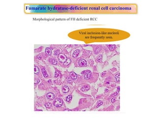 Approach to Renal cell carcinoma(RCC).pptx