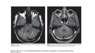 Jubelt B, Mihai C, Li T, et al. Rhombencephalitis / brainstem encephalitis. Curr Neurol Neurosci Rep.
 