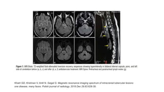 Khatri GD, Krishnan V, Antil N, Saigal G. Magnetic resonance imaging spectrum of intracranial tubercular lesions:
one disease, many faces. Polish journal of radiology. 2018 Dec 29;83:628-39.
 