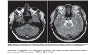 Akman-Demir G, Serdaroglu P, Tasci B, Neuro-Behçet Study Group*. Clinical patterns of neurological involvement in Behçet's
disease: evaluation of 200 patients. Brain. 1999 Nov 1;122(11):2171-82.
 