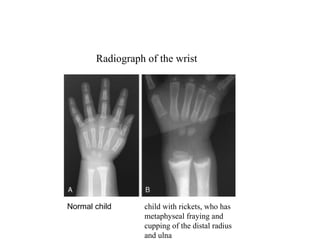 pediatrics endocrineapproach to rickets.pptx