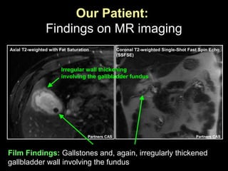 Axial T2-weighted with Fat Saturation
Partners CAS
Our Patient:
Findings on MR imaging
Gallbladder sludge and stones
Coronal T2-weighted Single-Shot Fast Spin Echo
(SSFSE)
Partners CAS
Irregular wall thickening
involving the gallbladder fundus
Film Findings: Gallstones and, again, irregularly thickened
gallbladder wall involving the fundus
 
