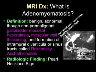 MRI Dx: What is
Adenomyomatosis?
• Definition: benign, abnormal
though non-premalignant
gallbladder mucosal
hyperplasia, muscular wall
thickening, and formation of
intramural diverticula or sinus
tracts called Rokitansky-
Aschoff sinuses
• Radiologic Finding: Pearl
Necklace Sign
uodenuuodenu
mm
Haradome, H. et al. Radiology 2003. 227(1): 80-8.
Very
sm
all cystic
structures
Very
sm
all cystic
structures
(Pearl Necklace
Sign)
(Pearl Necklace
Sign)
MultipleMultiple
gallbladder stonesgallbladder stones
 