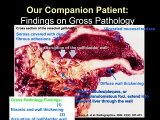 Our Companion Patient:
Findings on Gross Pathology
Diffuse wall thickening
Serosa covered with dense
fibrous adhesions
Ulcerated mucosal surface
Yellow nodules/plaques, orYellow nodules/plaques, or
xanthogranulomatous foci, extend intoxanthogranulomatous foci, extend into
adjacent liver through the walladjacent liver through the wall
Levy, A. et al. Radiographics. 2002. 22(2): 387-413.
Cross section of the resected gallbladderCross section of the resected gallbladder
Disruption of the gallbladder wall
Gross Pathology Findings:
(1)
fibrosis and wall thickening
(2)
 