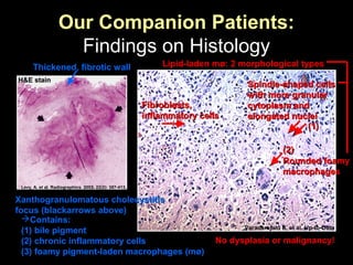 Our Companion Patients:
Findings on Histology
Varadarajulu S, et al. Up-to-Date
Fibroblasts,Fibroblasts,
inflammatory cellsinflammatory cells
Spindle-shaped cellsSpindle-shaped cells
with more granularwith more granular
cytoplasm andcytoplasm and
elongated nucleielongated nuclei
Lipid-laden mø: 2 morphological types
Levy, A. et al. Radiographics. 2002. 22(2): 387-413.
Xanthogranulomatous cholecystitisXanthogranulomatous cholecystitis
focus (blackarrows above)focus (blackarrows above)
H&E stainH&E stain
Thickened, fibrotic wall
Contains:
(1) bile pigment
(2) chronic inflammatory cells
(3) foamy pigment-laden macrophages (mø)
No dysplasia or malignancy!
Rounded foamyRounded foamy
macrophagesmacrophages
(1)(1)
(2)(2)
 