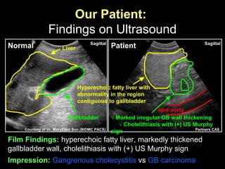 Our Patient:
Findings on Ultrasound
Patient
√ Marked irregular GB wall thickening
√ Cholelithiasis with (+) US Murphy
sign
Abd aorta
Impression: Gangrenous cholecystitis vs GB carcinoma
Partners CAS
Normal Liver
Gallbladder
Courtesy of Dr. MaryEllen Sun (BIDMC PACS)
Hyperechoic fatty liver with
abnormality in the region
contiguous to gallbladder
Film Findings: hyperechoic fatty liver, markedly thickened
gallbladder wall, cholelithiasis with (+) US Murphy sign
SagittalSagittal
 