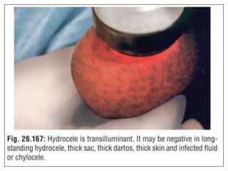 Hydrocleses Approach to Scrotal Swelling.pptx