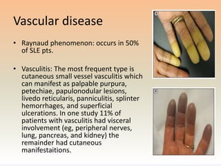 Sle Pattern Periphiral Rim Fana Approach to sle | PPTX