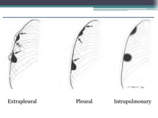 Approach to solitary pulmonary nodule | PPTX