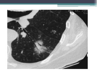 Approach to solitary pulmonary nodule | PPTX