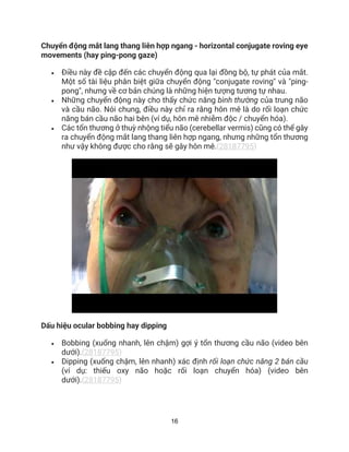 16
Chuyển động mắt lang thang liên hợp ngang - horizontal conjugate roving eye
movements (hay ping-pong gaze)
• Điều này đề cập đến các chuyển động qua lại đồng bộ, tự phát của mắt.
Một số tài liệu phân biệt giữa chuyển động "conjugate roving" và "ping-
pong", nhưng về cơ bản chúng là những hiện tượng tương tự nhau.
• Những chuyển động này cho thấy chức năng bình thường của trung não
và cầu não. Nói chung, điều này chỉ ra rằng hôn mê là do rối loạn chức
năng bán cầu não hai bên (ví dụ, hôn mê nhiễm độc / chuyển hóa).
• Các tổn thương ở thuỳ nhộng tiểu não (cerebellar vermis) cũng có thể gây
ra chuyển động mắt lang thang liên hợp ngang, nhưng những tổn thương
như vậy không được cho rằng sẽ gây hôn mê.(28187795)
Dấu hiệu ocular bobbing hay dipping
• Bobbing (xuống nhanh, lên chậm) gợi ý tổn thương cầu não (video bên
dưới).(28187795)
• Dipping (xuống chậm, lên nhanh) xác định rối loạn chức năng 2 bán cầu
(ví dụ: thiếu oxy não hoặc rối loạn chuyển hóa) (video bên
dưới).(28187795)
 