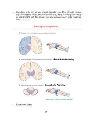 24
• Cần được phân biệt với các chuyển động lan tỏa, đồng bộ hoặc có nhịp
điệu - có thể gợi ý tổn thương não do thiếu oxy, trạng thái động kinh không
co giật (NCSE), ngộ độc lithium, ngộ độc cephalosporin hoặc thuốc trừ
sâu.(20130300)
Đáp ứng vận động với đau
• Cách thăm khám:
 