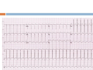 Svt Loop Approach to svt | PPT