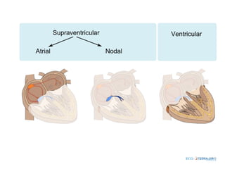 Approach to svt | PPT