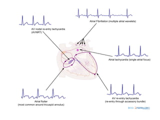 Svt Loop Approach to svt | PPT