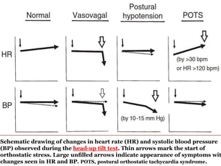 36
Schematic drawing of changes in heart rate (HR) and systolic blood pressure
(BP) observed during the head-up tilt test. Thin arrows mark the start of
orthostatic stress. Large unﬁlled arrows indicate appearance of symptoms wit
changes seen in HR and BP. POTS, postural orthostatic tachycardia syndrome.
 
