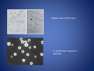 C. neoformans capsule in
India Ink
Hyphae seen in KOH stain
 