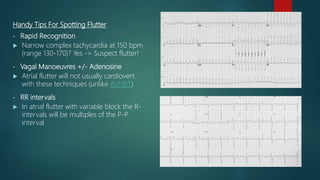 Handy Tips For Spotting Flutter
• Rapid Recognition
 Narrow complex tachycardia at 150 bpm
(range 130-170)? Yes -> Suspect flutter!
• Vagal Manoeuvres +/- Adenosine
 Atrial flutter will not usually cardiovert
with these techniques (unlike AVNRT)
• RR intervals
 In atrial flutter with variable block the R-
intervals will be multiples of the P-P
interval
 