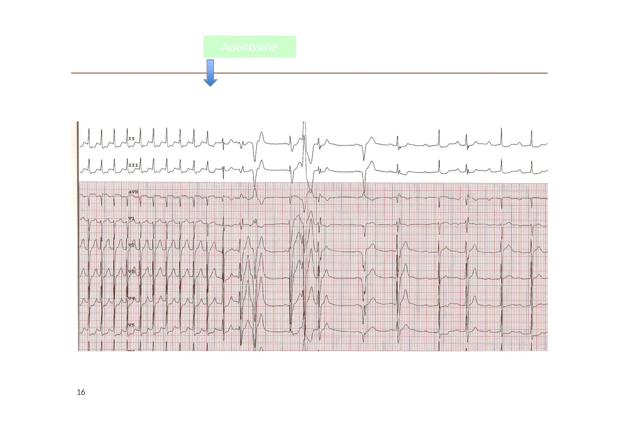 Adenosine
Adenosine
16
 