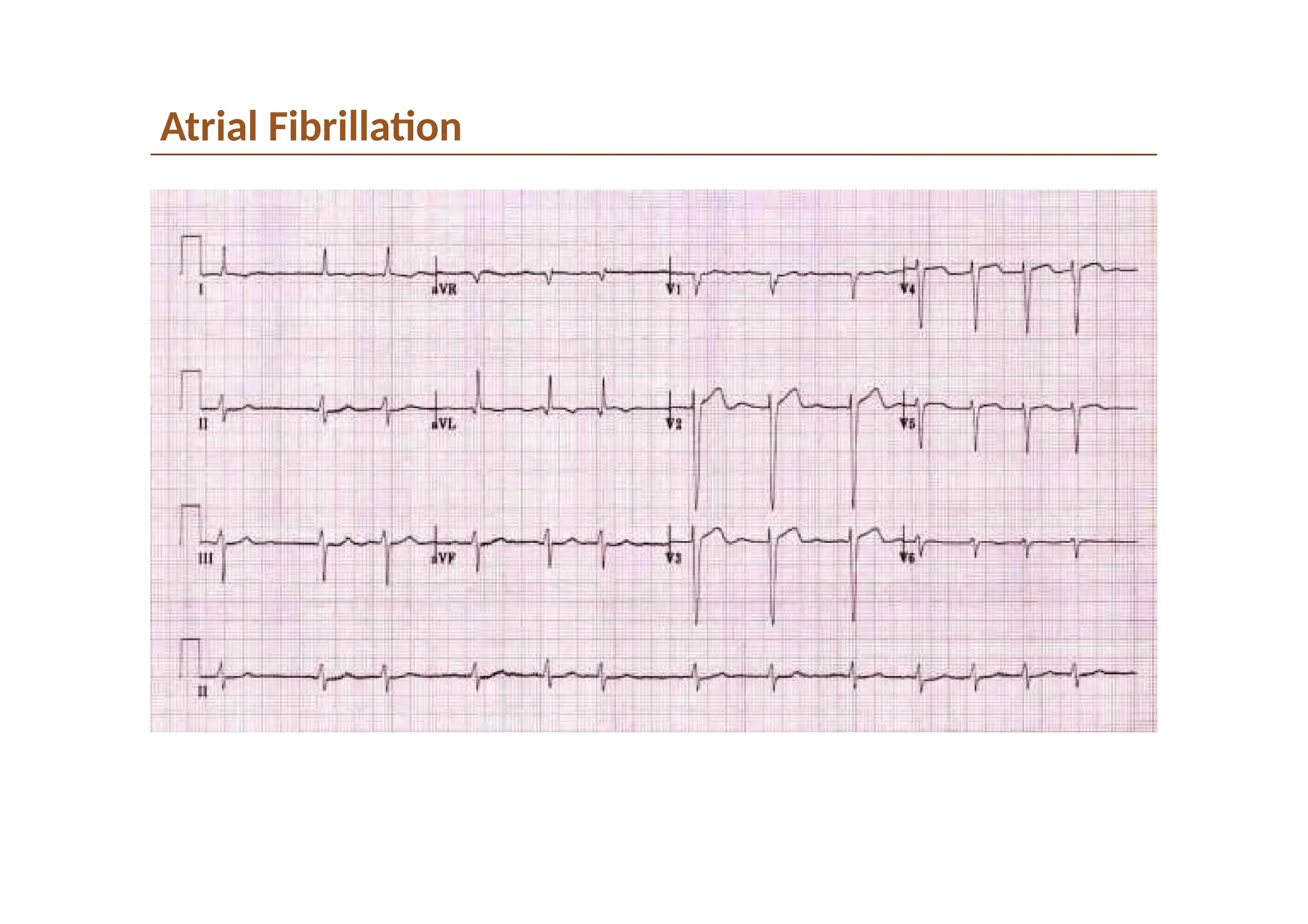Atrial Fibrillation
 