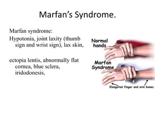Marfan’s Syndrome.
Marfan syndrome:
Hypotonia, joint laxity (thumb
sign and wrist sign), lax skin,
ectopia lentis, abnormally flat
cornea, blue sclera,
iridodonesis,
 
