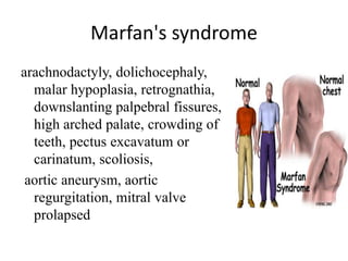 Marfan's syndrome
arachnodactyly, dolichocephaly,
malar hypoplasia, retrognathia,
downslanting palpebral fissures,
high arched palate, crowding of
teeth, pectus excavatum or
carinatum, scoliosis,
aortic aneurysm, aortic
regurgitation, mitral valve
prolapsed
 