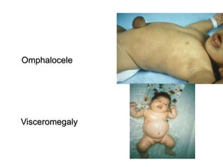 Omphalocele
Visceromegaly
 
