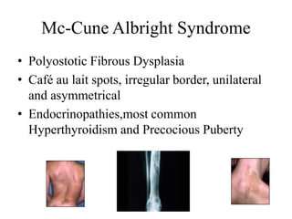 Mc-Cune Albright Syndrome
• Polyostotic Fibrous Dysplasia
• Café au lait spots, irregular border, unilateral
and asymmetrical
• Endocrinopathies,most common
Hyperthyroidism and Precocious Puberty
 