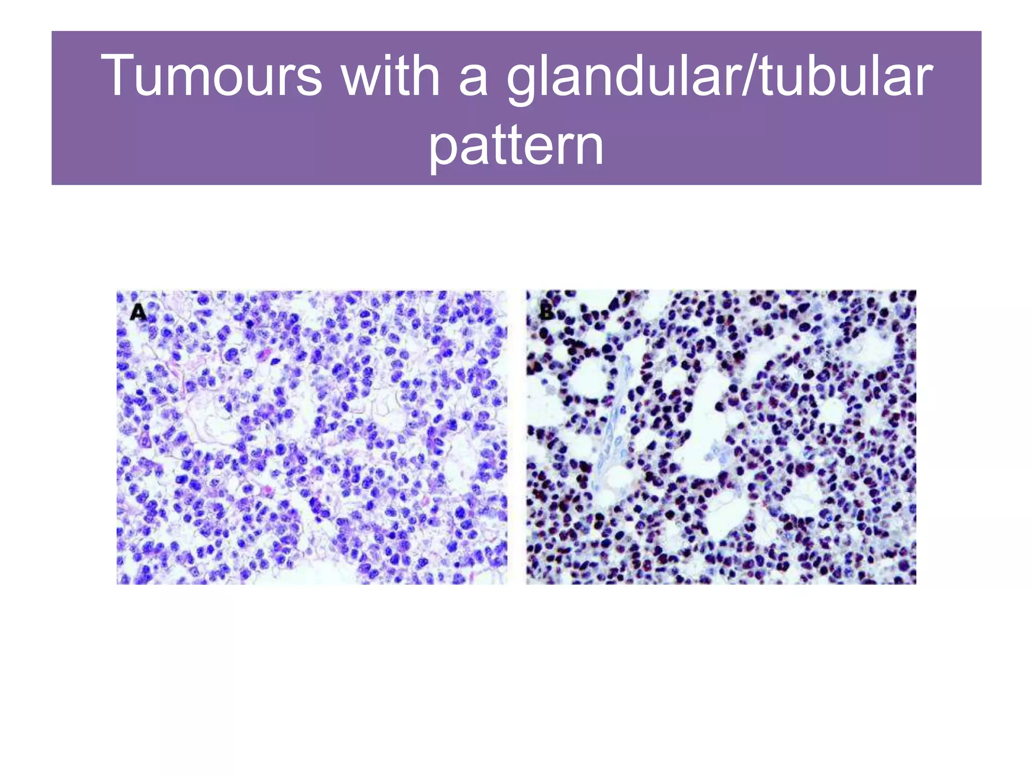 Tumours with a glandular/tubular
pattern
 
