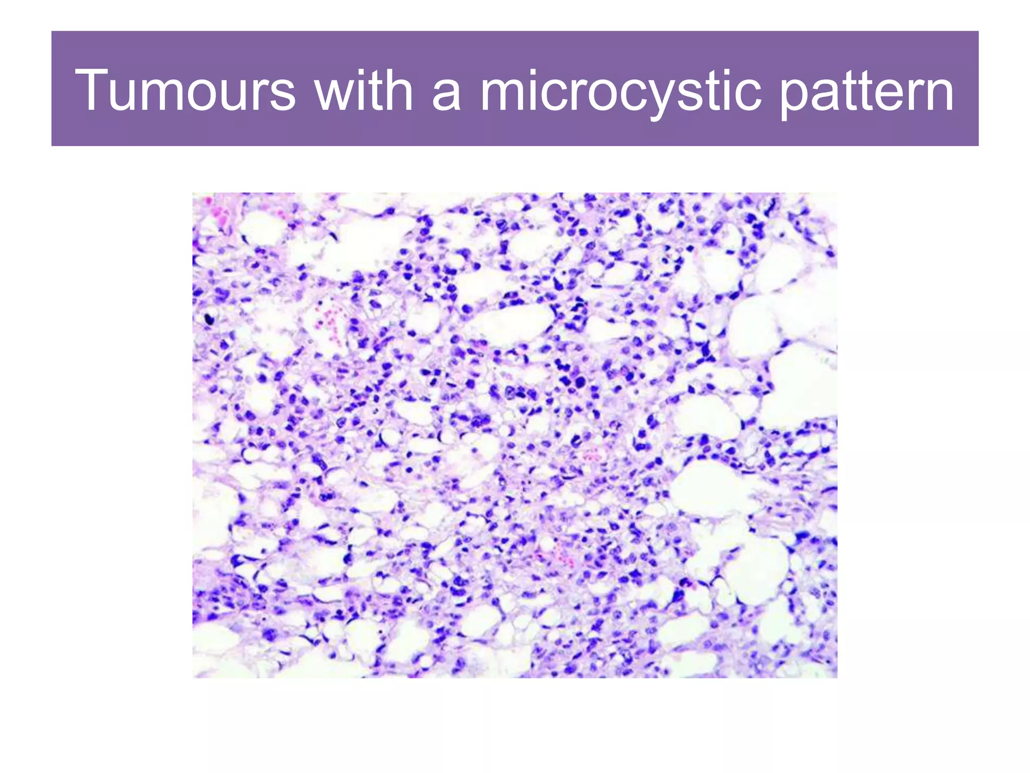 Tumours with a microcystic pattern
 