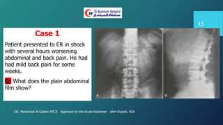DR. Mohamad Al-Gailani FRCS Approach to the Acute Abdomen AHH Riyadh, KSA
15
Case 1
Patient presented to ER in shock
with several hours worsening
abdominal and back pain. He had
had mild back pain for some
weeks.
Q: What does the plain abdominal
film show?
 