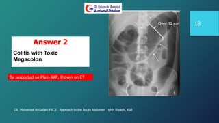 DR. Mohamad Al-Gailani FRCS Approach to the Acute Abdomen AHH Riyadh, KSA
18
Answer 2
Colitis with Toxic
Megacolon
Dx suspected on Plain AXR, Proven on CT
Over 12 cm
 