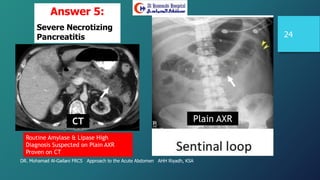 DR. Mohamad Al-Gailani FRCS Approach to the Acute Abdomen AHH Riyadh, KSA
24
Answer 5:
Severe Necrotizing
Pancreatitis
Routine Amylase & Lipase High
Diagnosis Suspected on Plain AXR
Proven on CT
CT Plain AXR
 