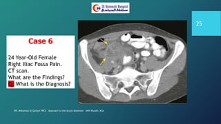 DR. Mohamad Al-Gailani FRCS Approach to the Acute Abdomen AHH Riyadh, KSA
25
Case 6
24 Year-Old Female
Right Iliac Fossa Pain.
CT scan.
What are the Findings?
Q: What is the Diagnosis?
 