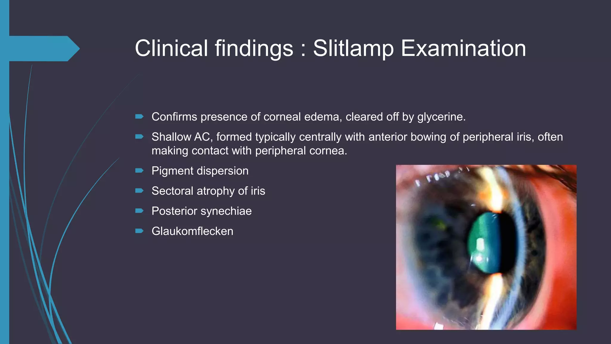 Clinical findings : Slitlamp Examination
 Confirms presence of corneal edema, cleared off by glycerine.
 Shallow AC, formed typically centrally with anterior bowing of peripheral iris, often
making contact with peripheral cornea.
 Pigment dispersion
 Sectoral atrophy of iris
 Posterior synechiae
 Glaukomflecken
 