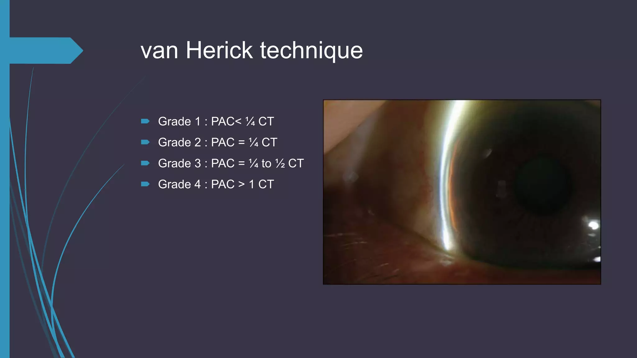 van Herick technique
 Grade 1 : PAC< ¼ CT
 Grade 2 : PAC = ¼ CT
 Grade 3 : PAC = ¼ to ½ CT
 Grade 4 : PAC > 1 CT
 