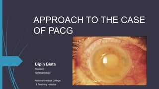 APPROACH TO THE CASE
OF PACG
Bipin Bista
Resident
Ophthalmology
National medical College
& Teaching Hospital
 