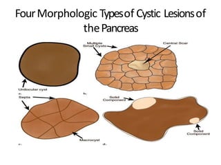 FourMorphologic Typesof Cystic Lesionsof
thePancreas
 