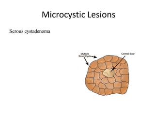 Microcystic Lesions
Serous cystadenoma
 