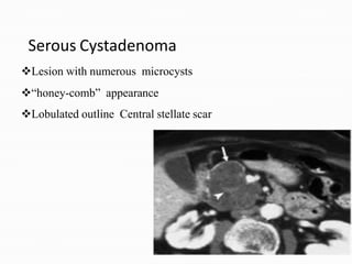 Serous Cystadenoma
Lesion with numerous microcysts
“honey-comb” appearance
Lobulated outline Central stellate scar
 