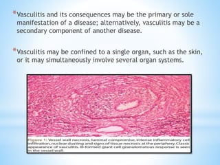 *Vasculitis and its consequences may be the primary or sole
manifestation of a disease; alternatively, vasculitis may be a
secondary component of another disease.
*Vasculitis may be confined to a single organ, such as the skin,
or it may simultaneously involve several organ systems.
 