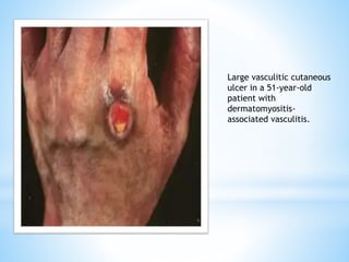 Large vasculitic cutaneous
ulcer in a 51-year-old
patient with
dermatomyositis-
associated vasculitis.
 