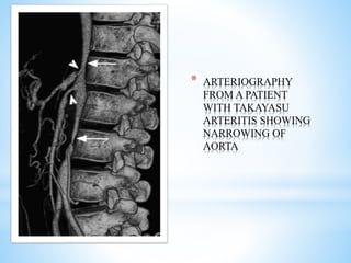 * ARTERIOGRAPHY
FROM A PATIENT
WITH TAKAYASU
ARTERITIS SHOWING
NARROWING OF
AORTA
 