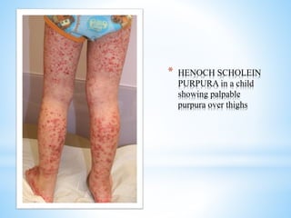 * HENOCH SCHOLEIN
PURPURA in a child
showing palpable
purpura over thighs
 
