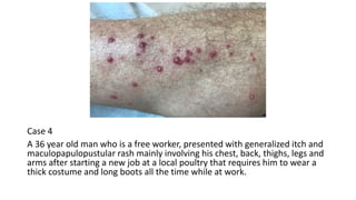 Promptu Rashes Approach to the patient with pruritus | PPTX
