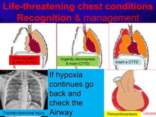 Life-threatening chest conditions
Recognition & management
Cover the defect.
& Insert (CTTD)
Urgently decompress
& Insert (CTTD) insert a CTTD
oxygen and
analgesics Pericardiocentesis
Maintain the
patient on oxygen
until complete
stabilization is
achieved and
SpO2 >95%. 1/25/2023
Tracheo-bronchial injury
If hypoxia
continues go
back and
check the
Airway
 