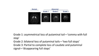 Grade 1: asymmetrical loss of putaminal tail—‘comma with full
stop’
Grade 2: bilateral loss of putaminal tails—‘two full stops’
Grade 3: Partial to complete loss of caudate and putaminal
signal—‘disappearing full stops’
 